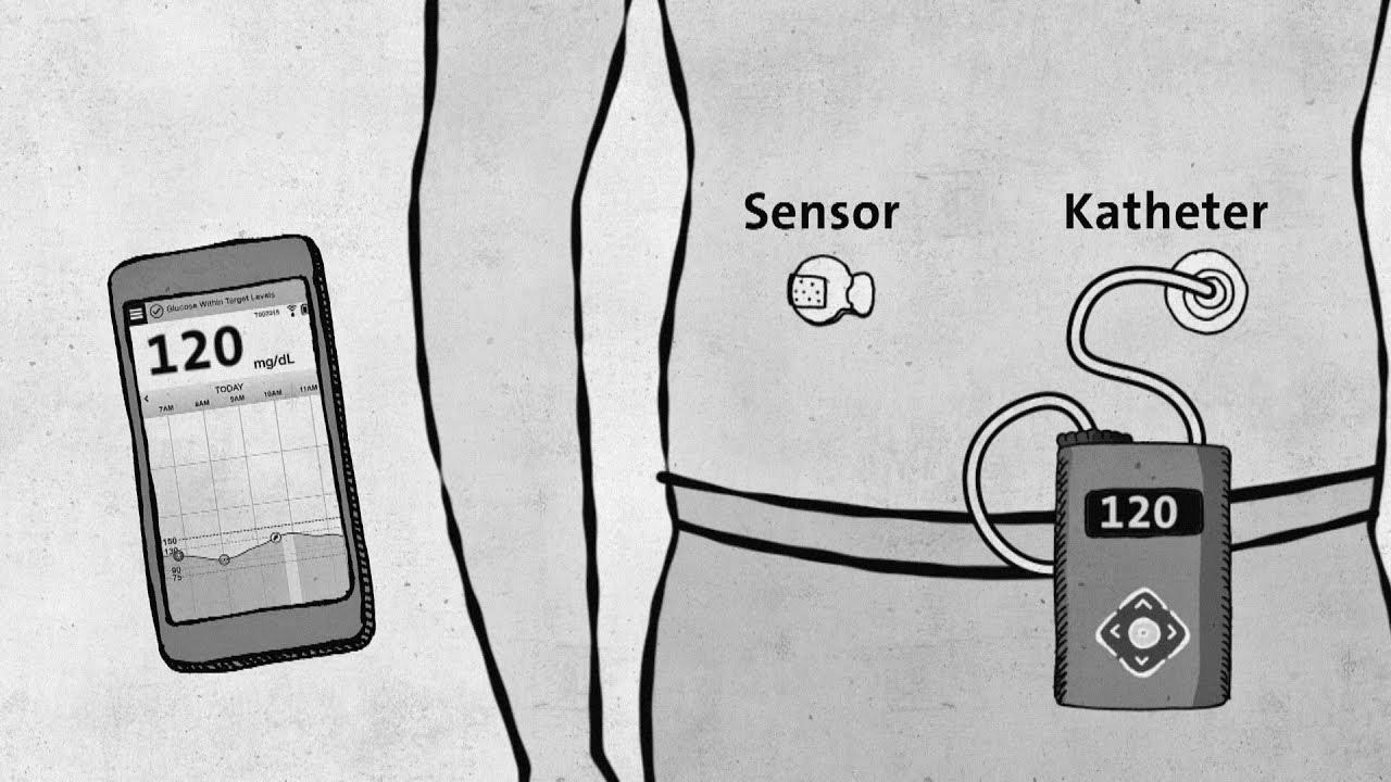 Kind 1 diabetes – modern know-how without approval – good to know